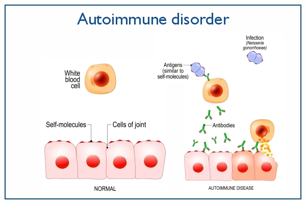 Wie funktioniert die Behandlung von Autoimmunerkrankungen in der Schweiz?