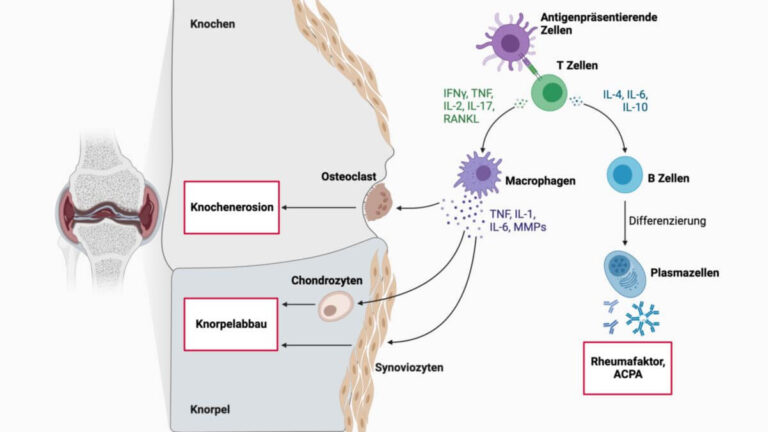 Wie funktioniert die Behandlung von Autoimmunerkrankungen wie Rheumatoider Arthritis in der Schweiz?