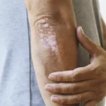 Bild zu Wie funktioniert die Behandlung von Hauterkrankungen wie Ekzemen und Psoriasis in der Schweiz?