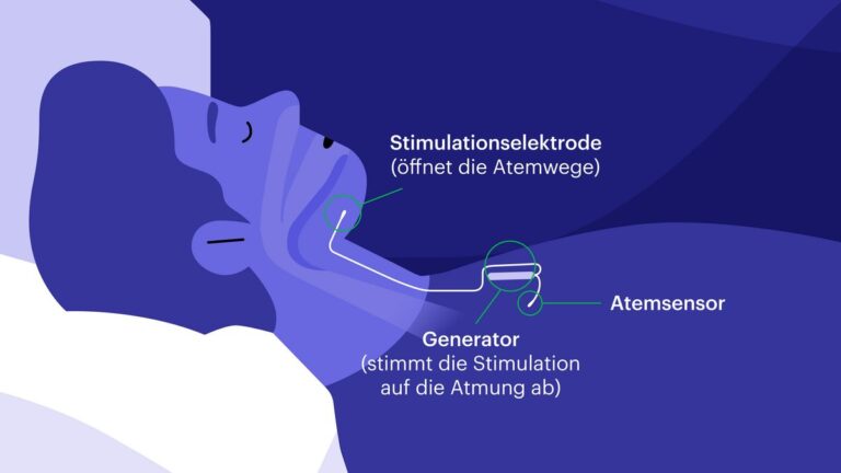 Wie funktioniert die Behandlung von Schlafapnoe im Schweizer Gesundheitssystem?