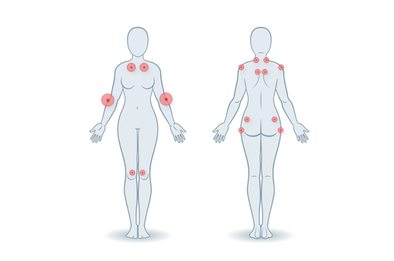 Wie unterstützt das Schweizer Gesundheitssystem Menschen, die an Fibromyalgie leiden?