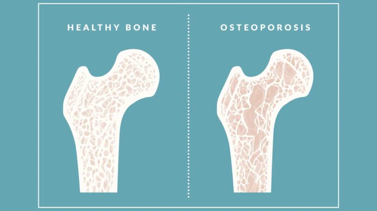 Wie wirkt sich regelmäßige Bewegung auf die Prävention von Osteoporose in der Schweiz aus?