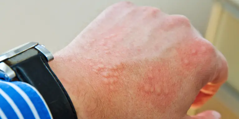 Wie funktioniert die Behandlung von Allergien in der Schweiz?
