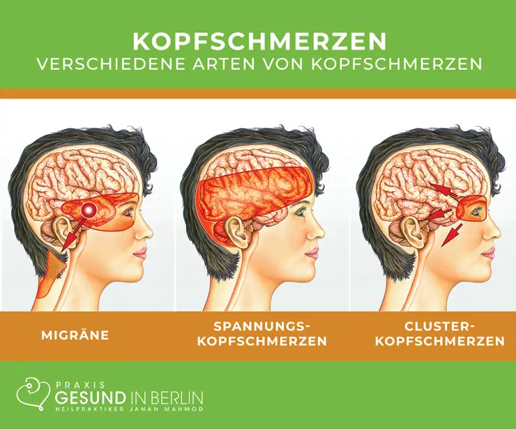 Wie funktioniert die Behandlung von Migräne und chronischen Kopfschmerzen in der Schweiz?