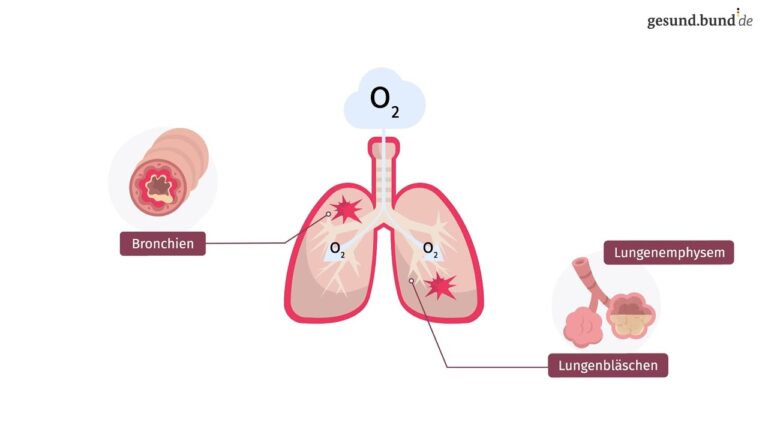 Wie funktioniert die Behandlung von chronischen Lungenerkrankungen wie COPD in der Schweiz?