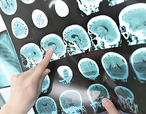 Wie unterstützt das Schweizer Gesundheitssystem Menschen mit Multipler Sklerose?